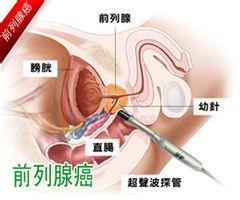前列腺囊腫患者在生活中應(yīng)該