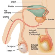 導(dǎo)致睪丸炎的病因有哪些?