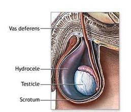 男性無精是有什么引起的