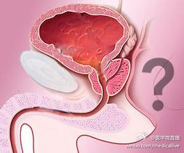 患了前列腺痛應(yīng)該注意些什么